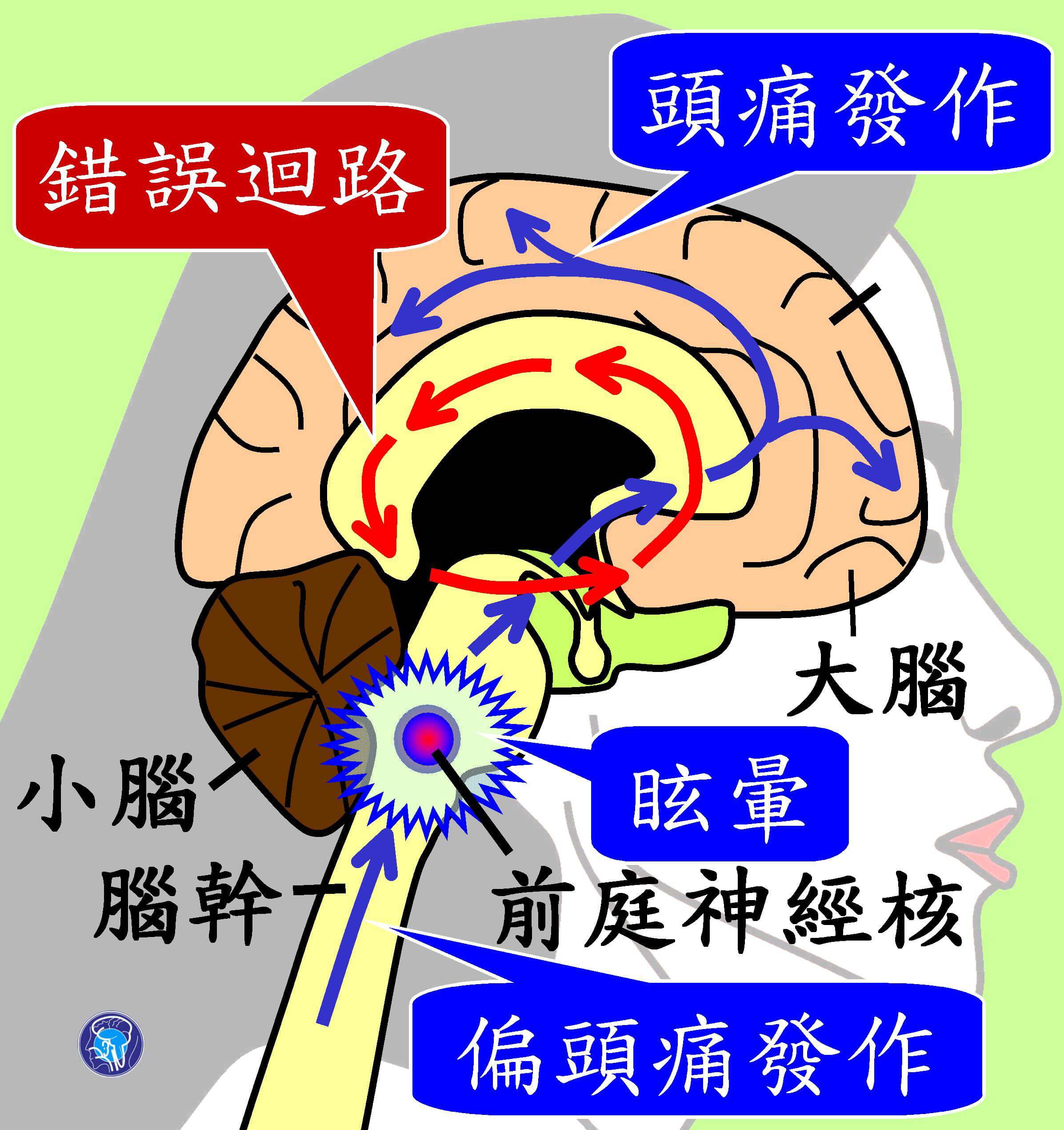 又痛又暈狂吃成藥？前庭性偏頭痛對症下藥才有用！ - 今健康